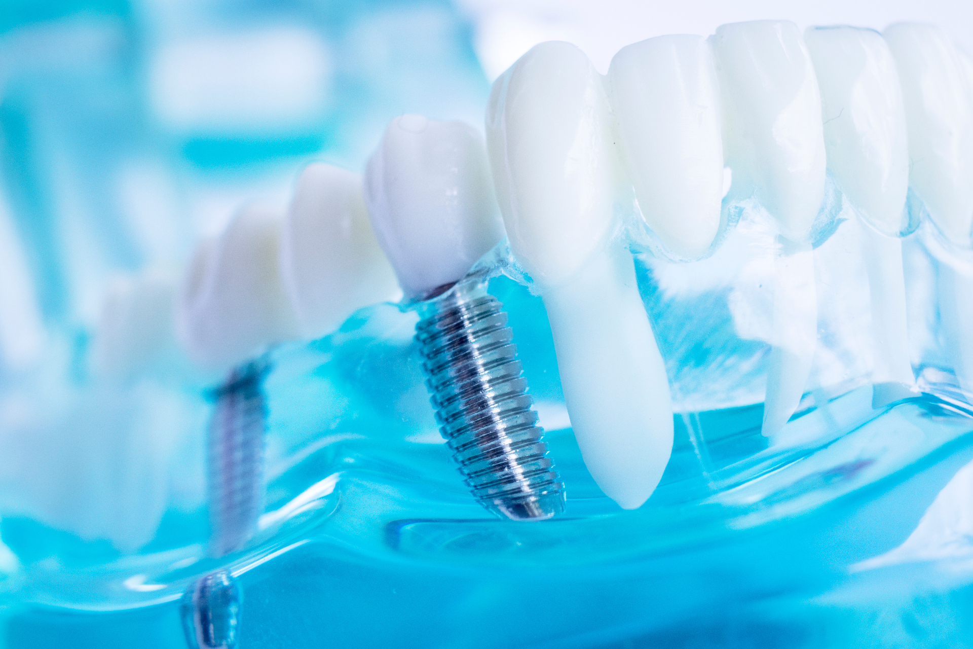 Dental Implants